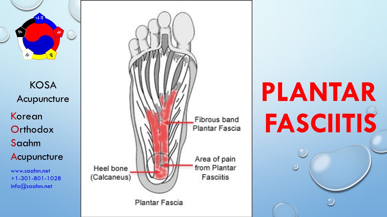 Plantar Fasciitis Treatment