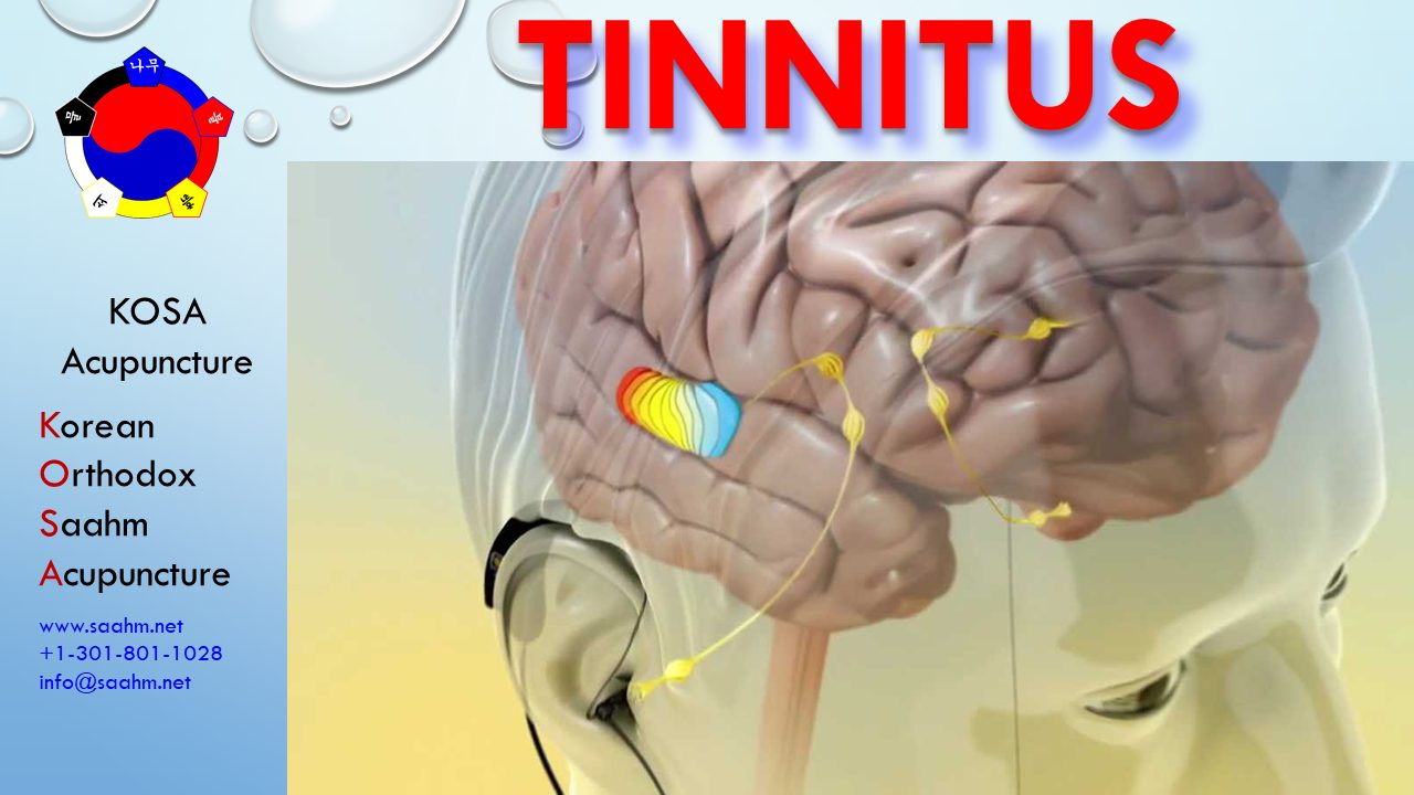 KOSA Acupuncture for Tinnitus