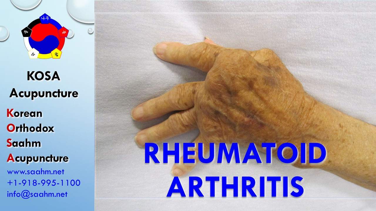 KOSA Acupuncture For Rheumatoid Arthritis