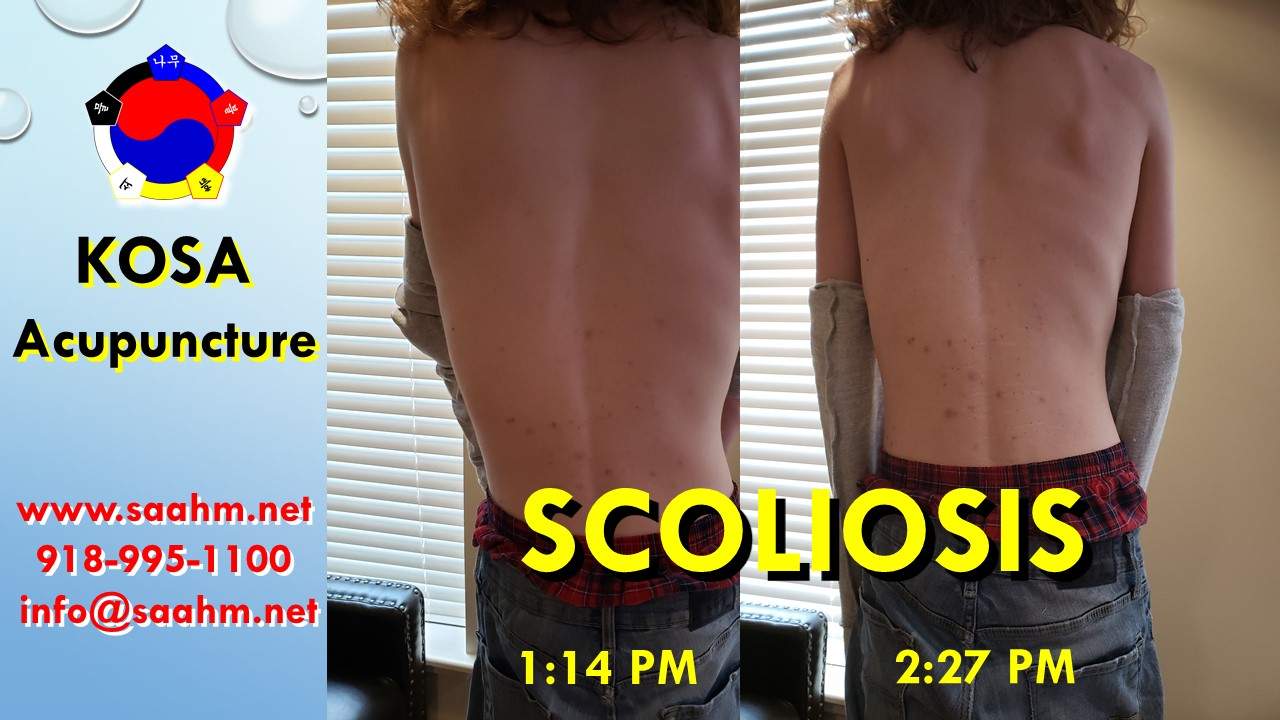 Scoliosis Before and After KOSA Acupuncture Treatment on 03/15/2022
