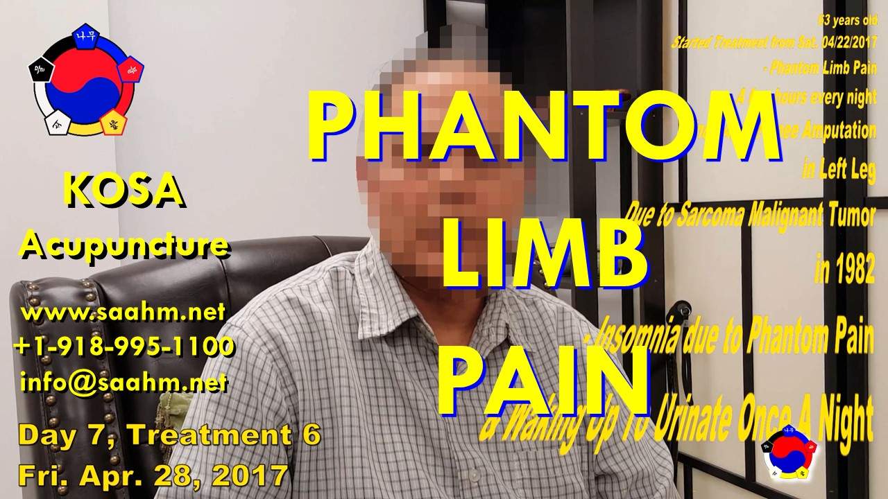 Phantom Limb Pain, Gout, Foot pain, and Insomnia Treatment By KOSA Acupuncture